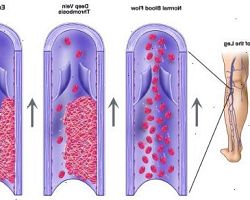 Ενημερωτική εκδήλωση με θέμα την φλεβική θρόμβωση